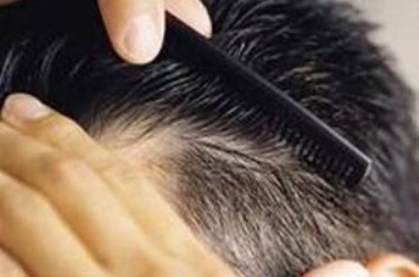 ریزش مو در مردان و ریزش مو زنان و تفاوت هایشان 1
