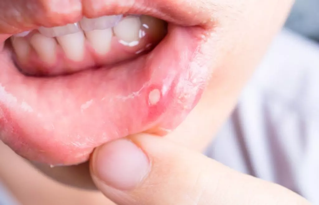 آفت دهان | دلیل آفت دهان چیست و راه درمان آفت دهان