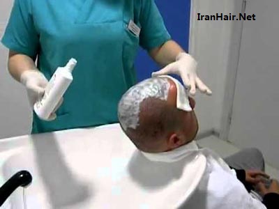 روش های کاشت مو در ایران