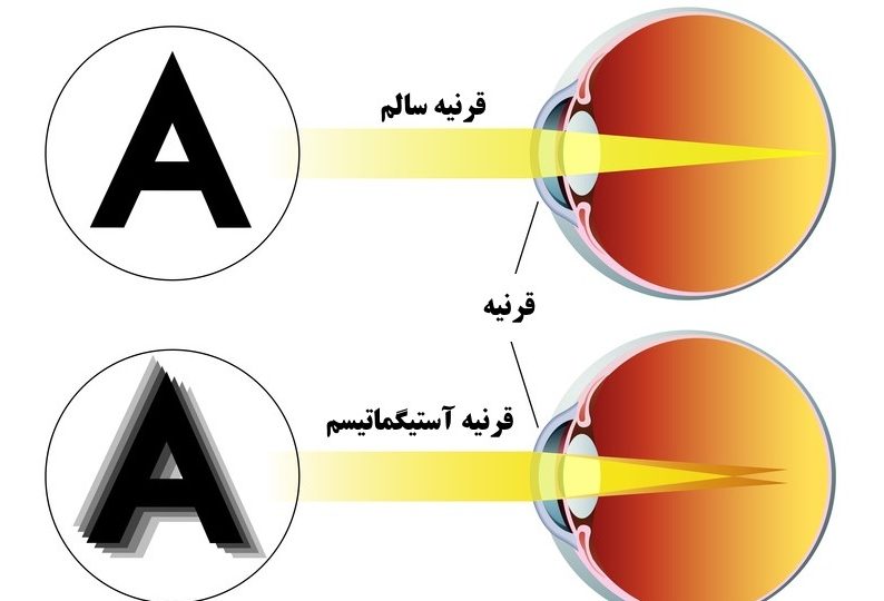 آستیگماتیسم آستیگماتیسم