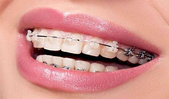 انجام ارتودنسی باعث بیشتر شدن عمر دندان می شود