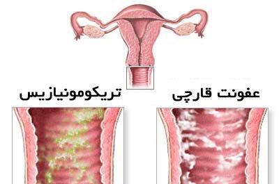 با نمک عفونت قارچی واژن و دیگر بیماری ها را از بین ببرید
