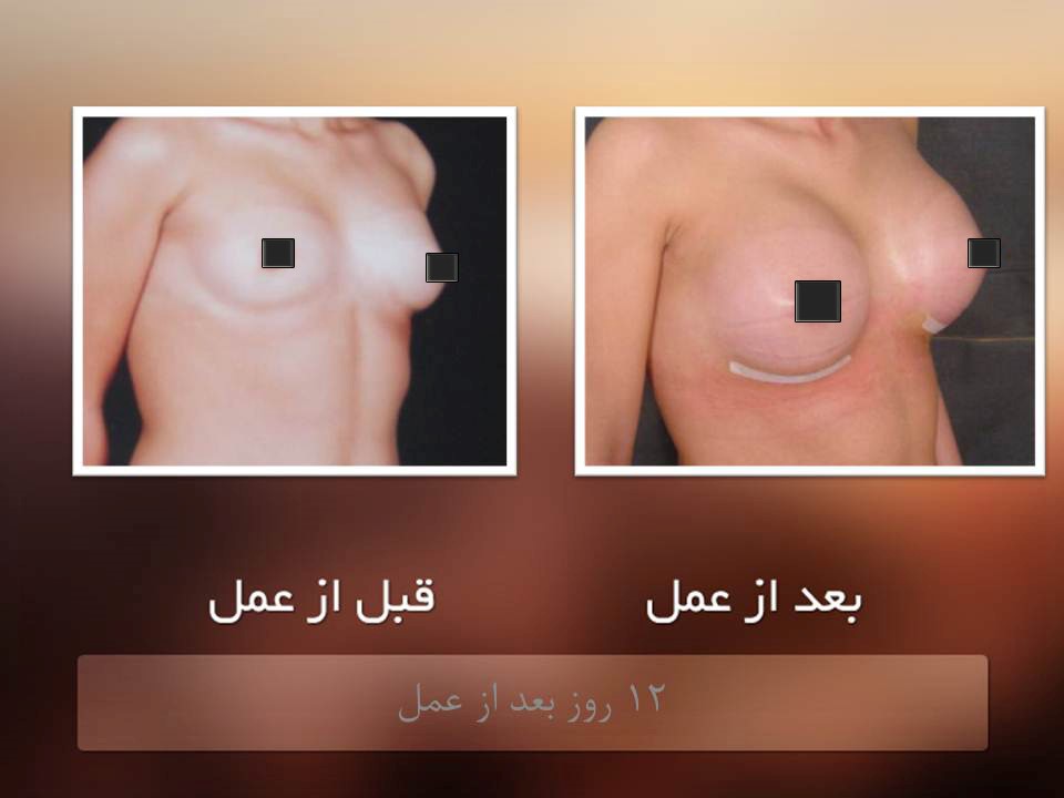 جراحی سینه