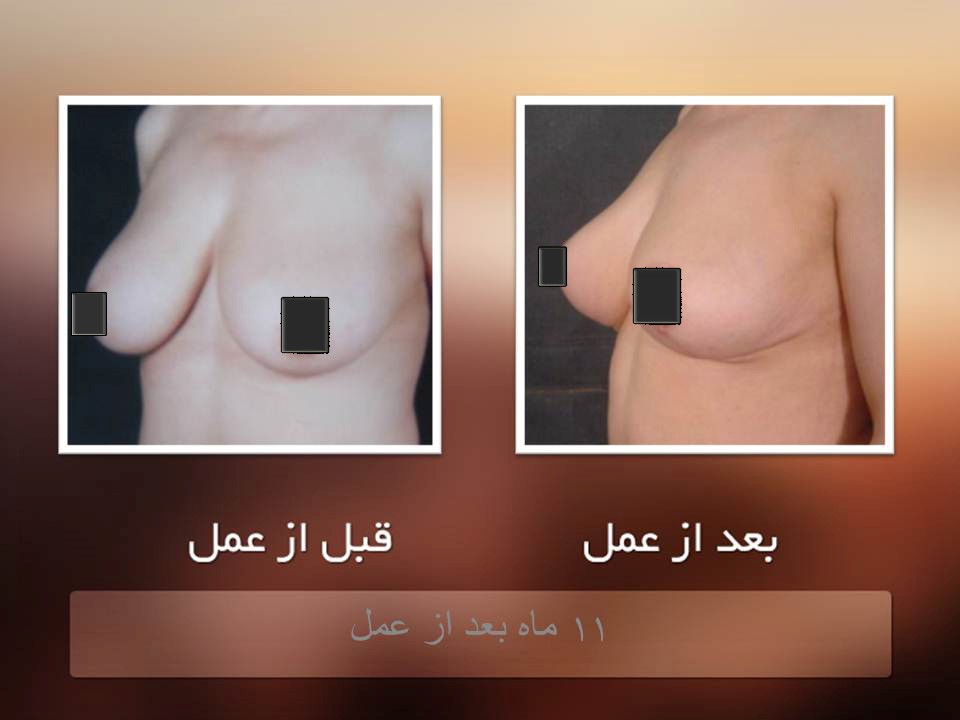 جراحی سینه