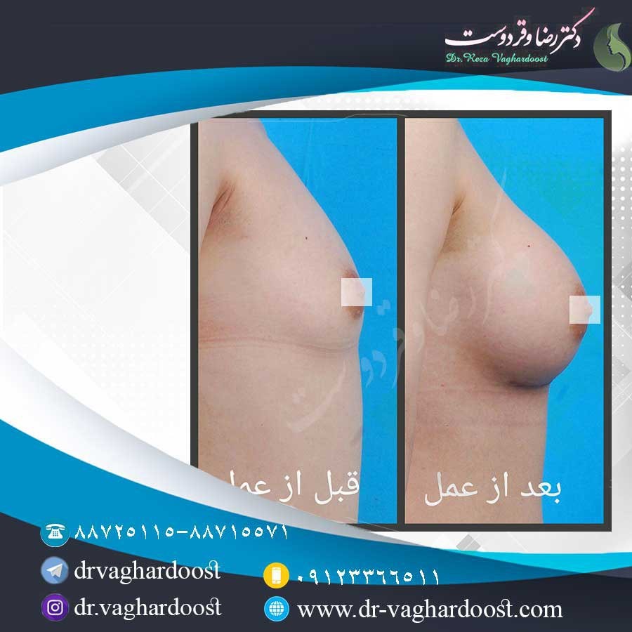 جراحی سینه