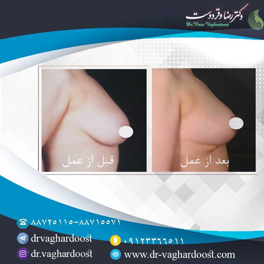 جراحی سینه