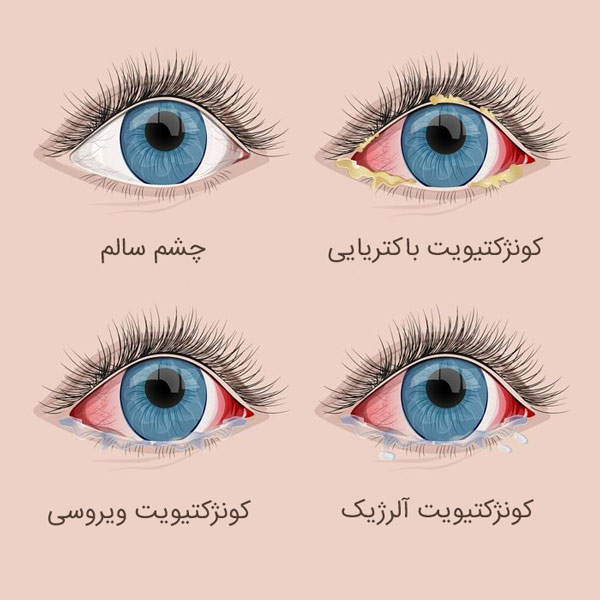 بیماری چشم صورتی