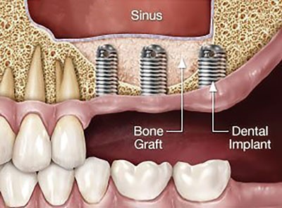 پیوند استخوان ایمپلنت دندان