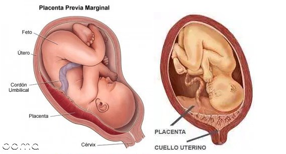جفت پایین در بارداری