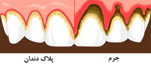 از بین بردن پلاک های دندان + ۱۰ روش پاکسازی دندان از پلاک و جرم
