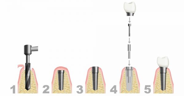 اطلاعاتی در مورد ایمپلنت دندان، جنس و اجزای آن و مراحل انجام 