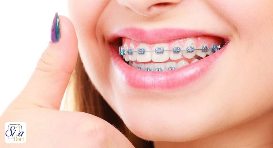 آشنایی بار مراحل سیم کشی دندان یا ارتودنسی