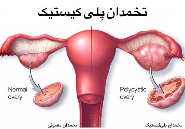 تخمدان پلی کیستیک e1623071552172
