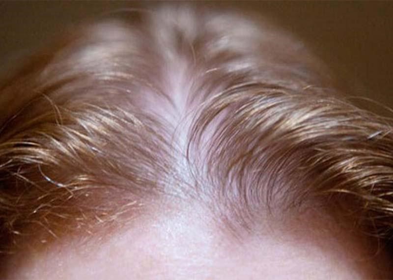 چگونه ریزش مو را متوقف کنیم؟