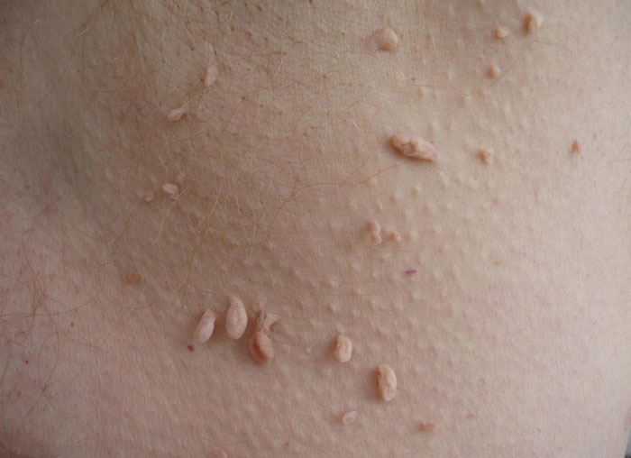 نحوه درمان برچسب های پوستی با روش های مختلف