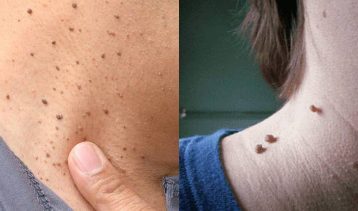 نحوه درمان برچسب های پوستی با روش های مختلف