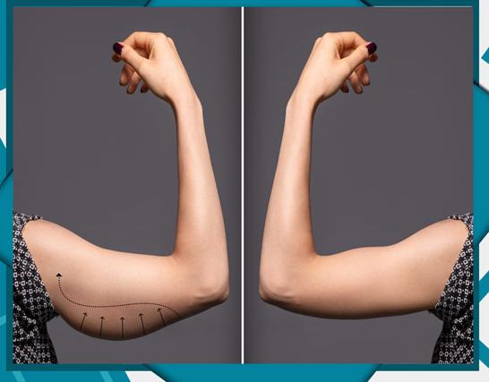 لیفت بازو (براکیوپلاستی)  و رفع افتادگی و شل شدگی پوست با 3 روش مناسب