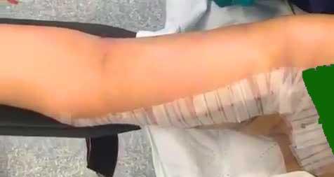 لیفت بازو (براکیوپلاستی)  و رفع افتادگی و شل شدگی پوست با 3 روش مناسب