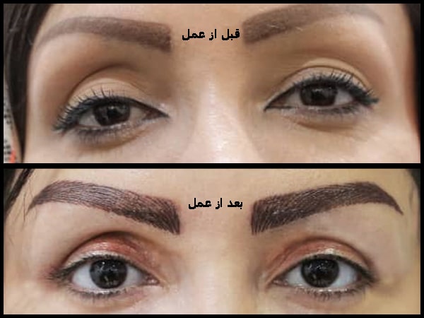 افتادگی پلک