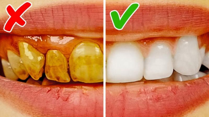 دلایل زردی دندان