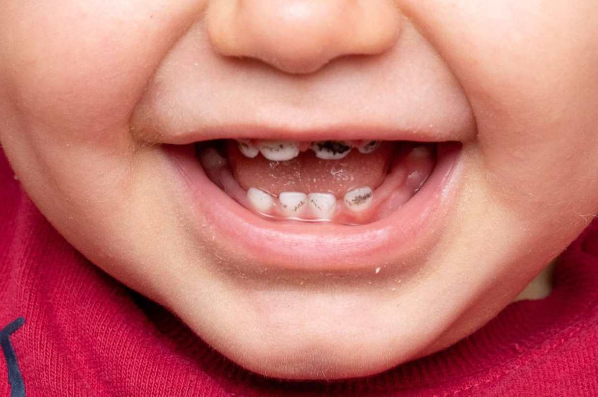 پوسیدگی دندان در کودکان (علائم، پیشگیری و درمان 