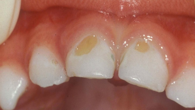 پوسیدگی دندان در کودکان (علائم، پیشگیری و درمان 