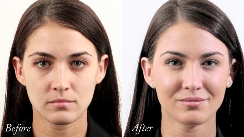 لیفتینگ صورت؛ با جراحی یا بدون جراحی؟